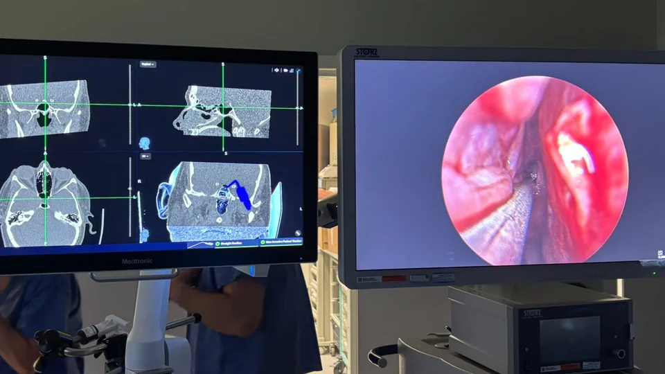 Navigation screen displaying CT views beside the endoscopic camera view of the sinuses